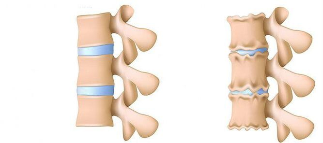 Lomber bölgenin osteokondrozu